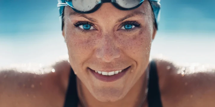 donna con iperpigmentazione solare donna con iperpigmentazione solare