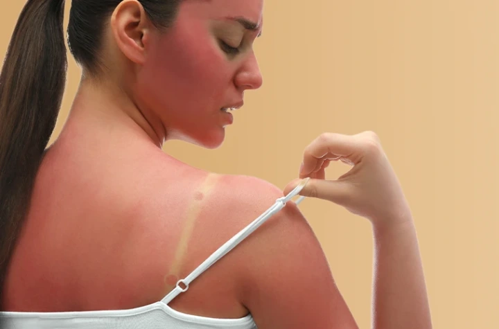 scottatura solare scottatura solare