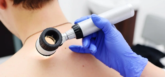 cancro della pelle e dermatoscopia