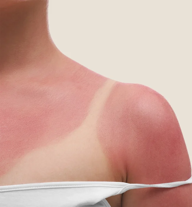 Mild sunburn symptoms showing red inflamed skin with first degree burn characteristics