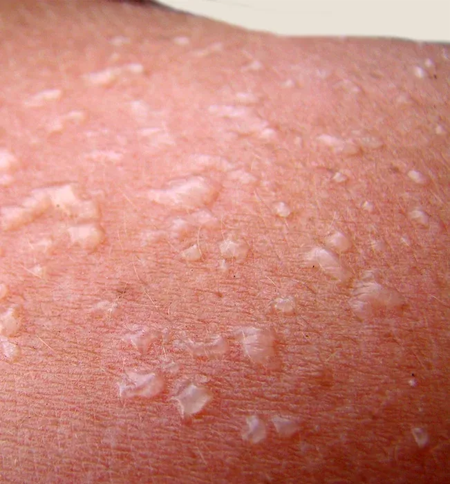 Severe sunburn with fluid-filled blisters showing second degree burn symptoms requiring medical attention