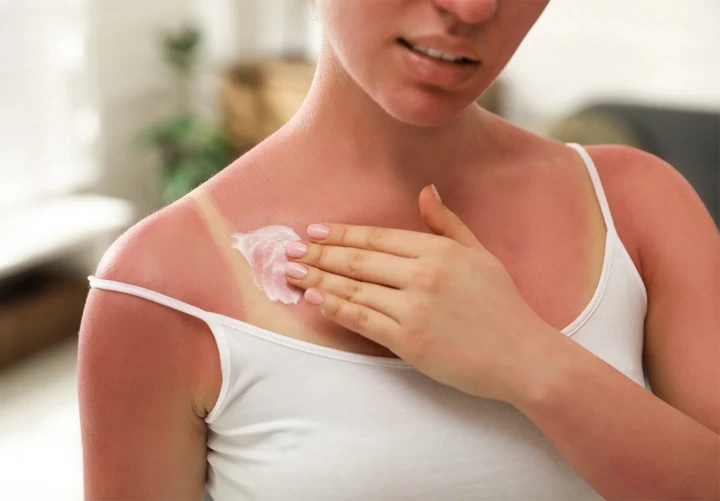 Come applicare crema doposole scottature rimedi naturali Come applicare crema doposole scottature rimedi naturali