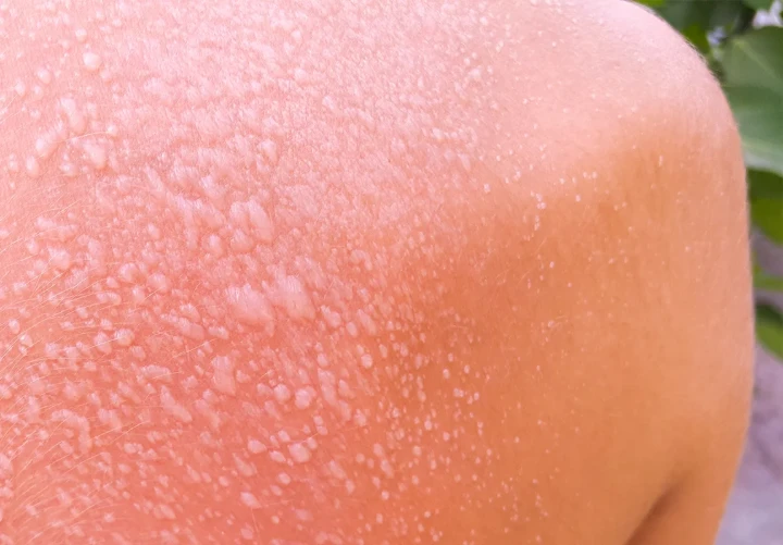 Scottature solari gravi vesciche bolle cure mediche Scottature solari gravi vesciche bolle cure mediche